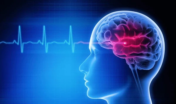 профілактика повторного інсульту з асундексіаном