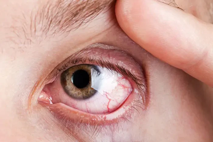 Danegaptide як пероральна терапія діабетичної ретинопатії