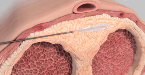 лікування гострої хвороби Пейроні за допомогою Perovial
