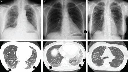 обстеження при інтерстиційній хворобі легень